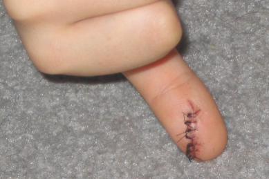 Yuck!! Oooh, seven stitches!